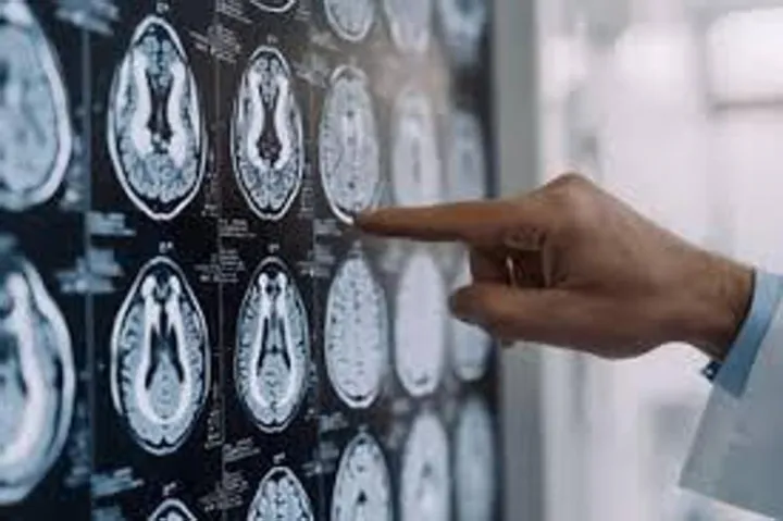 Centro Dbs Pavia, 100 interventi di neurostimolazione profonda per Parkinson