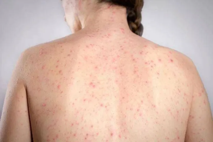 Morbillo, l'allarme dell'infettivologo Andreoni: 